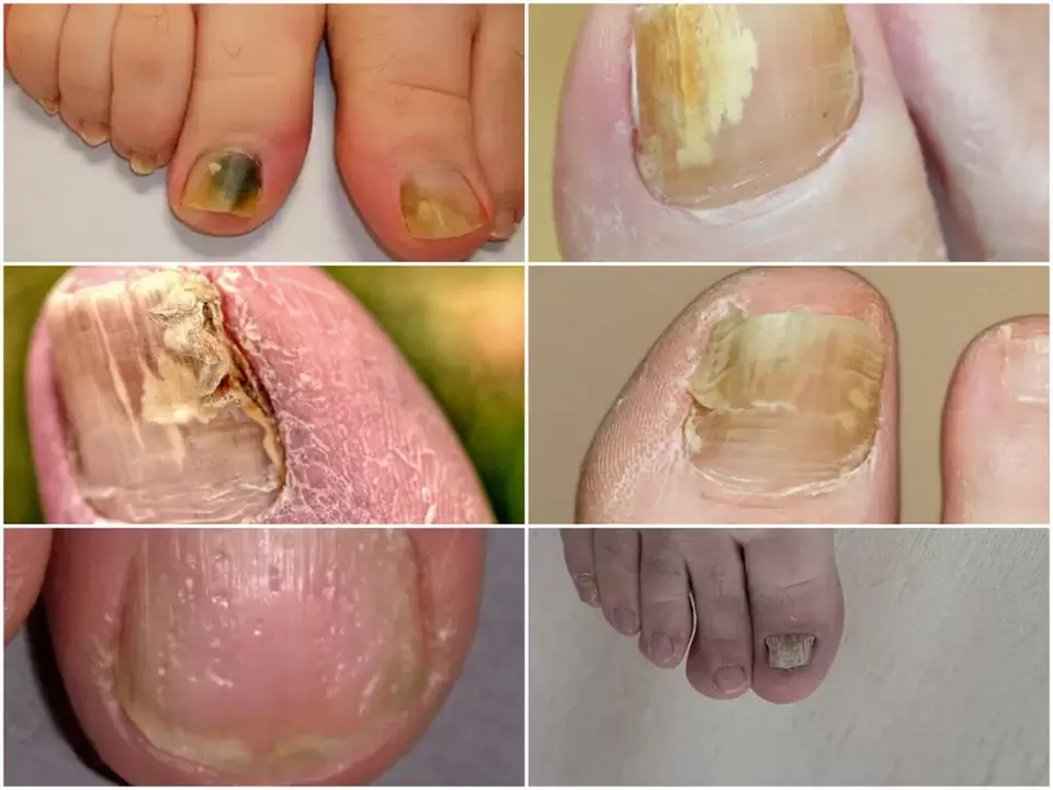 Onychomycosis sintomak - iltzeen kolorea eta egitura aldaketak